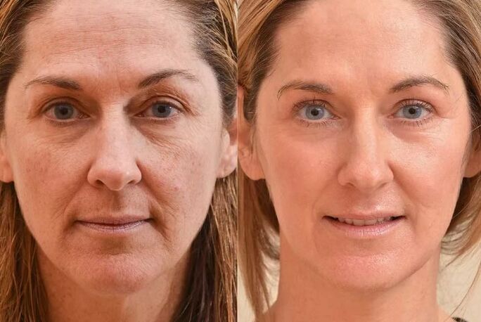 Rejuvenescimento do rosto antes e depois