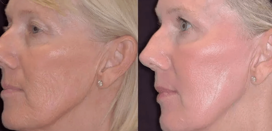 Fototermólise a laser antes e depois