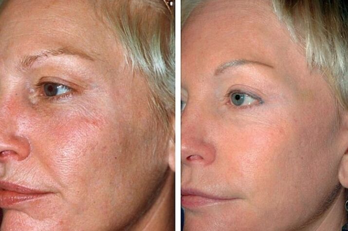 Antes e depois do procedimento de rejuvenescimento