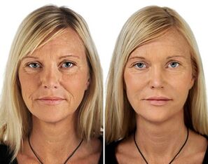 antes e depois