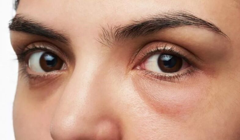 Sacos sob os olhos, inchando