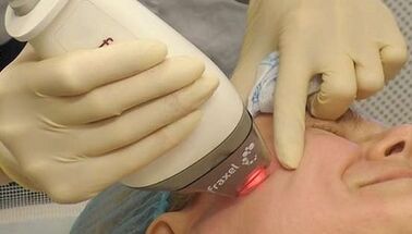 Como é realizado o rejuvenescimento fracionado da pele