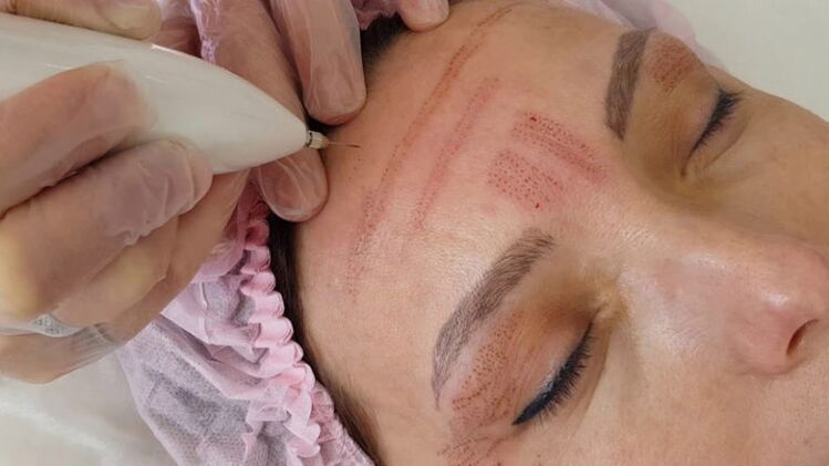 Rejuvenescimento facial plasmático