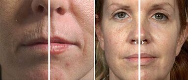 antes e depois do rejuvenescimento fracionado da pele