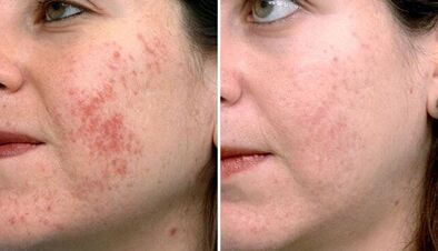 fotos antes e depois do rejuvenescimento fracionado da pele