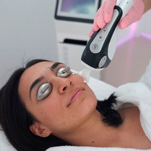 Tratamento facial da pele com laser fracionado