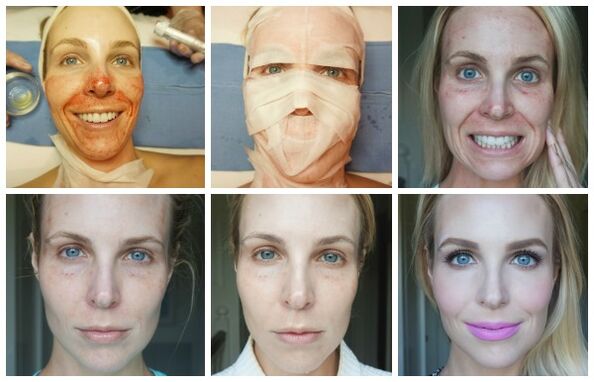 Estágios da cicatrização da pele facial após levantamento de plasma bem-sucedido