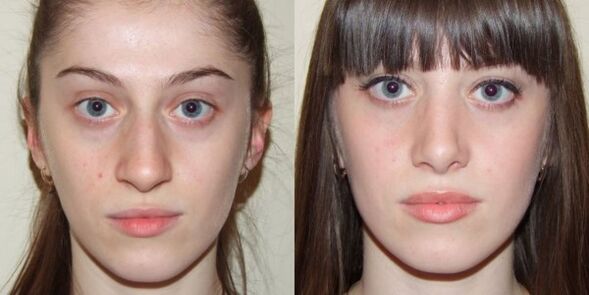 Menina antes e depois do rejuvenescimento da pele facial com plasma