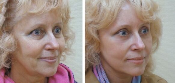 Mulher antes e depois do rejuvenescimento da pele facial com plasma
